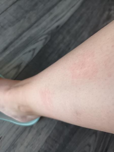 Červené fľaky na nohách