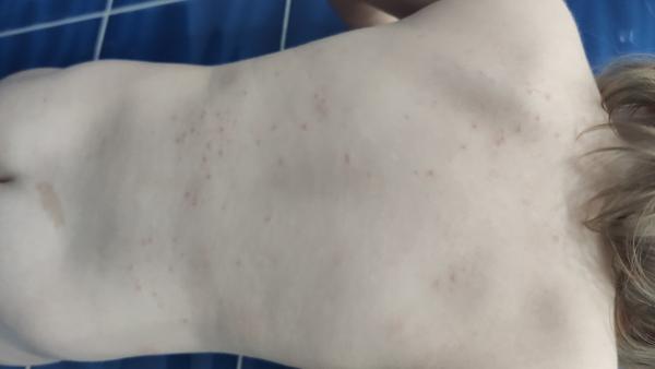 Aké vyrážky má moje 17 mesačné dieťa?