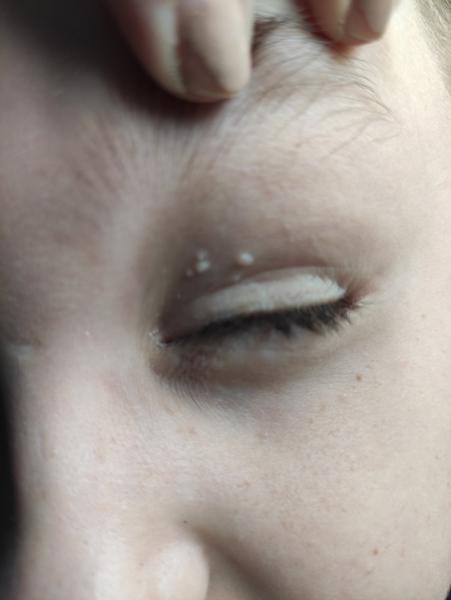 Výrastky nad okom 12-ročného