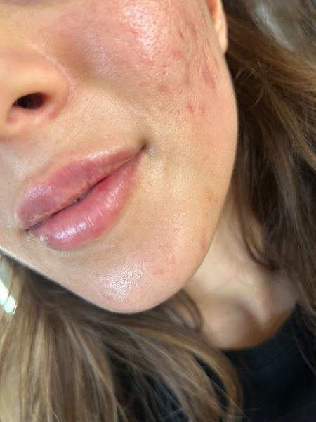 Prečo mám opuch na hornej pere po aplikácii výplne?