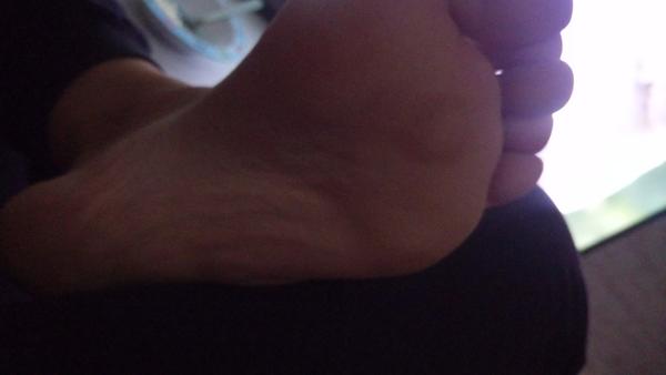 Čo môže znamenať hrčka na chodidle?