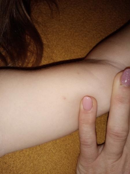 Má moje dieťa kiahne?