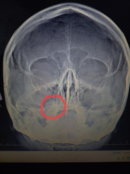 Spôsobuje cysta v ústach komplikácie?