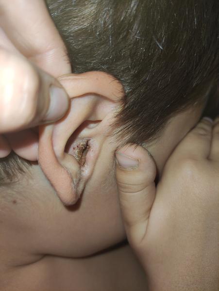 Chrasty v uchu u 9-ročného