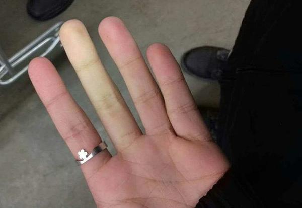 V zime mi zamrznú aj štyri prsty na ruke. O aký problém ide?