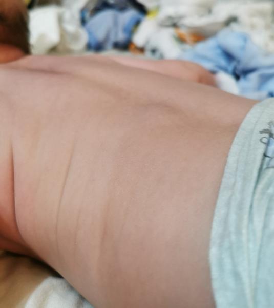 Divná hrčka pri chrbtici u 6 mesačného bábätka