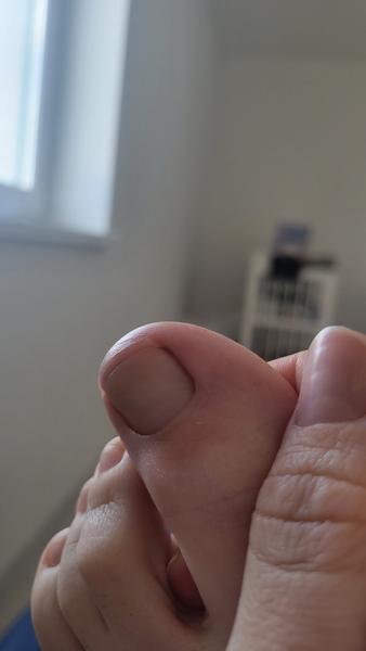 Bolesť palca po pedikúre: Ako si pomôcť?