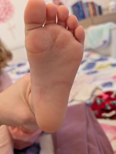 Opakujúce sa vyrážky na nohách trojročného dieťaťa