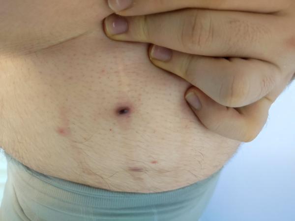 Je možné, že ide o vyrážku s krvnou podliatinou?