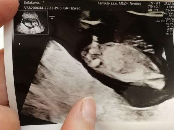 Pohlavie - 12. týždeň