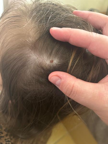 Máte dieťa a problém so zväčšujúcim sa znamienkom?