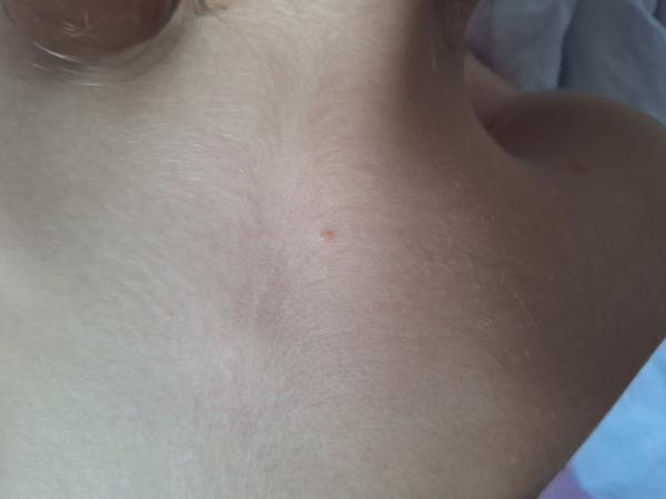 Sú to začínajúce kiahne u dieťaťa?