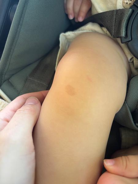 Pigmentové flaky u ročného dieťaťa