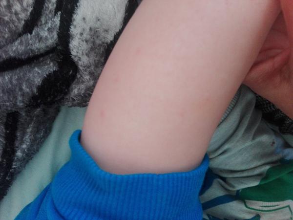 Čo sú to za vyrážky na synových nohách?