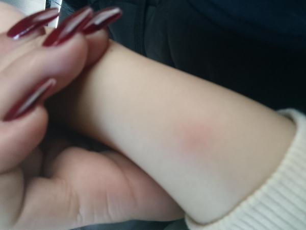 Sú vyrážky u dcérky spôsobené plošticami?