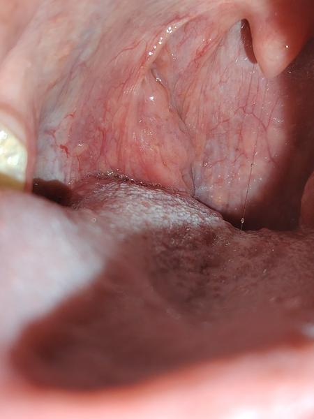 Podráždenie mandlí