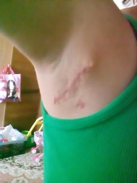 Vypuklina po odobratí tukového tkaniva