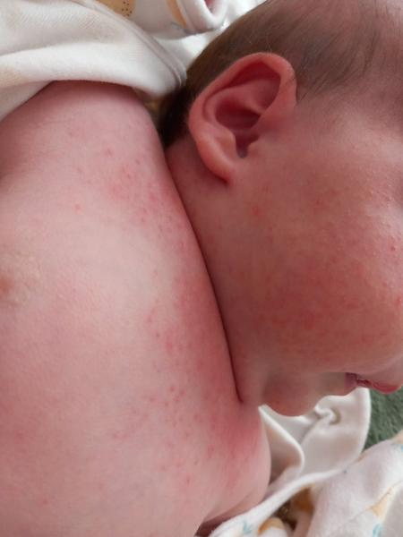 Čo spôsobuje vyrážky u päťtýždňového dieťaťa?