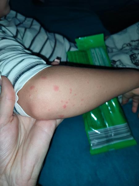 Ako riešiť nečakaný výsyp u 6-ročného dieťaťa?