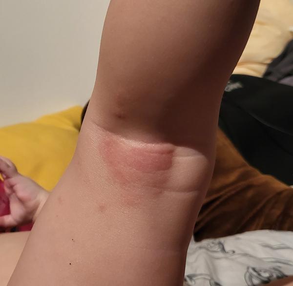 Kožné problémy u 16-mesačnej dcéry: Čo pomôže?