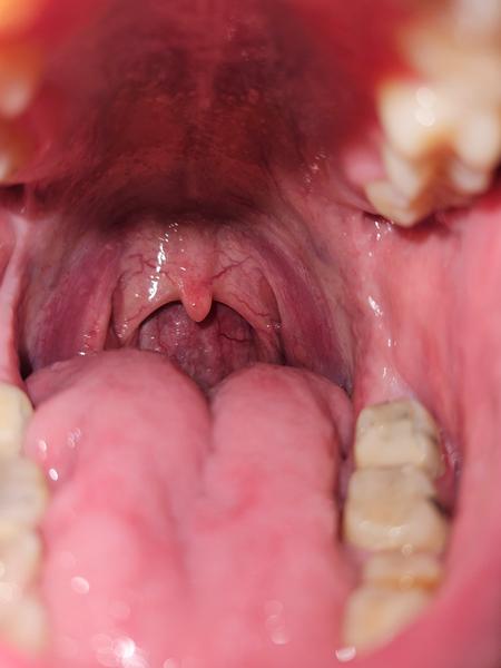 Bolesť hrdla po vyberaní zubného nervu