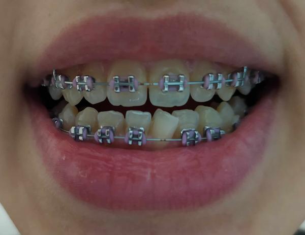 Dolný zubný strojček na krivom zube