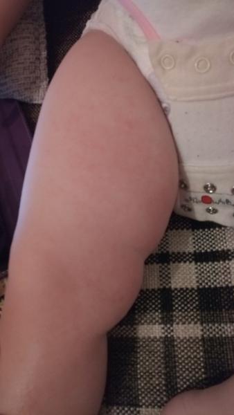 Má moja dvojročná dcérka ekzém, alebo reakciu na perkarbonát sodný?