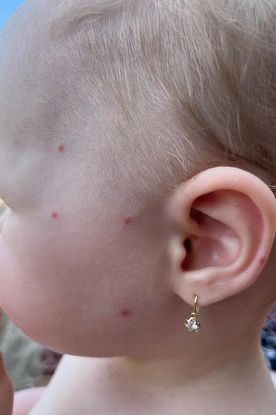 Čo znamenajú tieto vyrážky na tvári a končatinách?