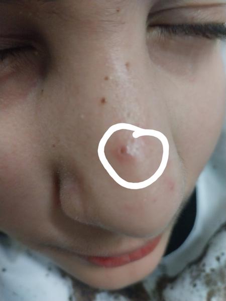 Čo spôsobuje čiernu bodku na nose u detí?