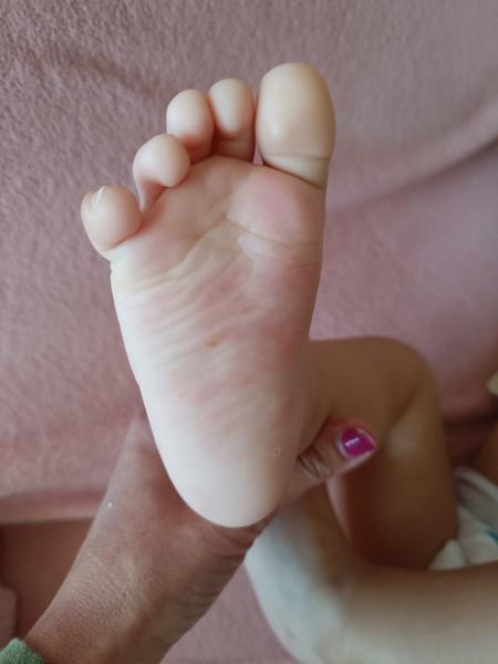 Opakujúci sa problém s vyrážkami na chodidlách dieťaťa