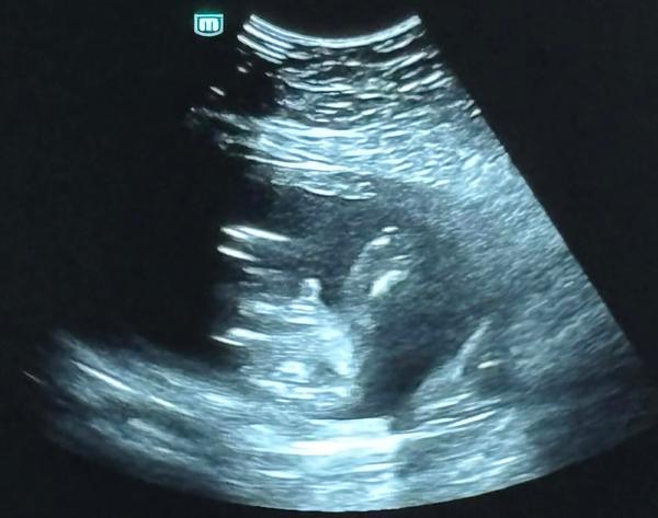 Sono v 20. týždni tehotenstva - pohlavie bábätka