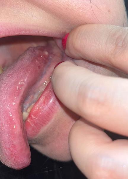 Biela tvrdá vyrážka na jazyku. Čo to môže byť?