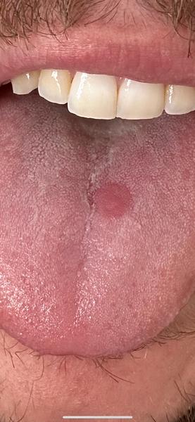 Je tento fľak na jazyku niečo vážne?