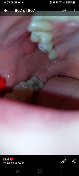 Aký boľavý výrastok mám v ústnej dutine?