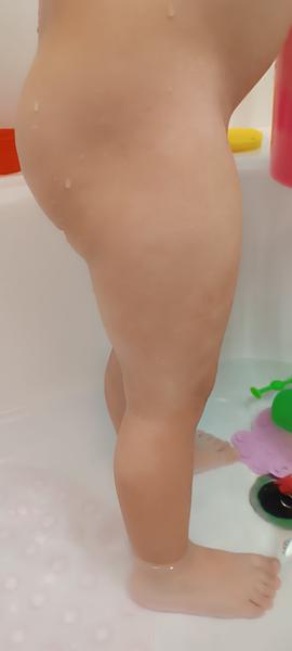 Biele mapy na pokožke detí: Čo ich spôsobuje?