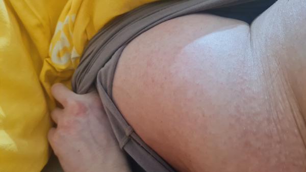 Prečo mám svrbivé vyrážky na stehnách a bruchu v tehotenstve?