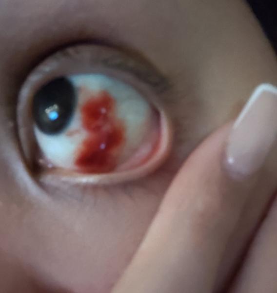 Prečo sa mi v oku rozlieva krv?