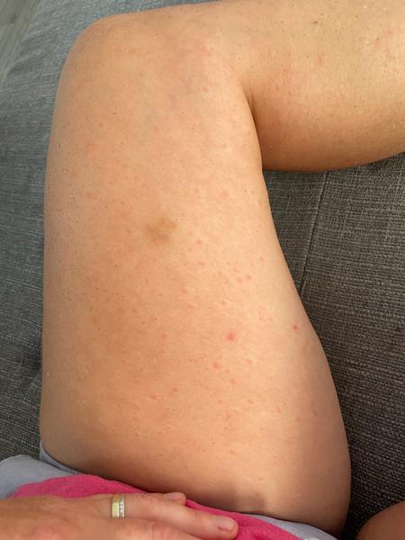 Čo znamená výsyp na tele?