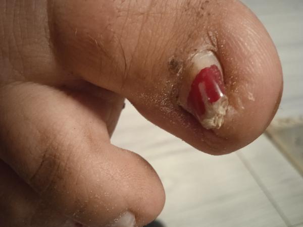 Ako liečiť problémové palce na nohách?