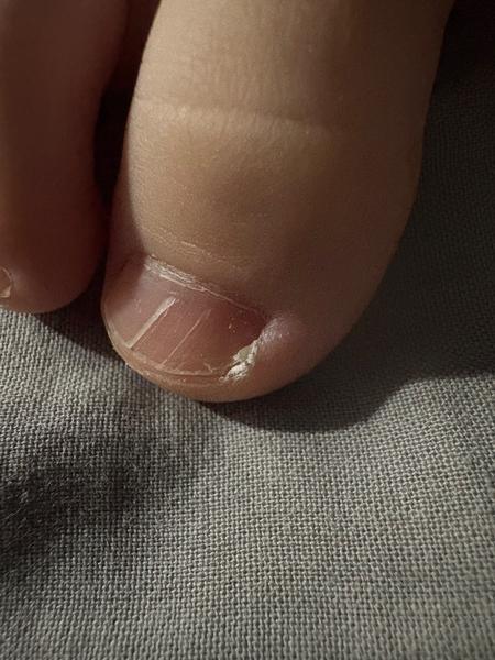 Zádery na palcoch u detí