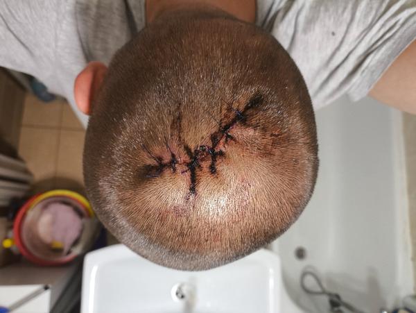 Chirurgický zákrok - odstránenie akné vo vlasoch