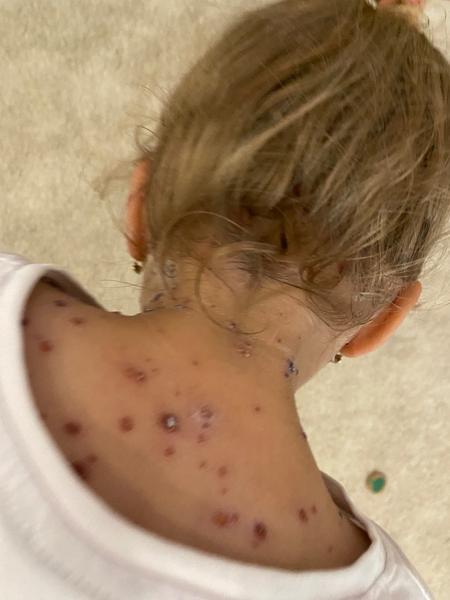 Výzor pokožky po kiahňach a starostlivosť