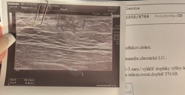 Hrčka v prsníku u manžela