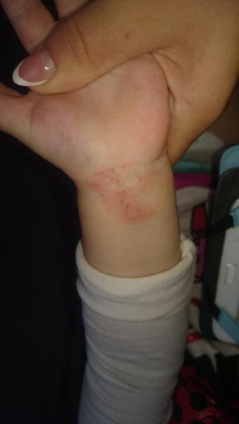 Neustále fľaky na zápästiach