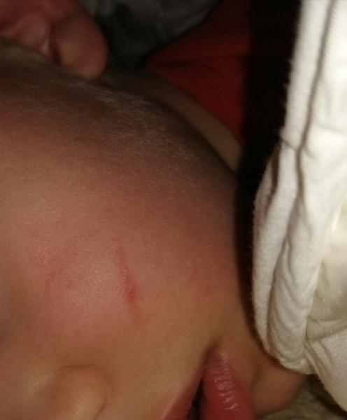 Je možné odstrániť dieťaťu jazvu po úraze?