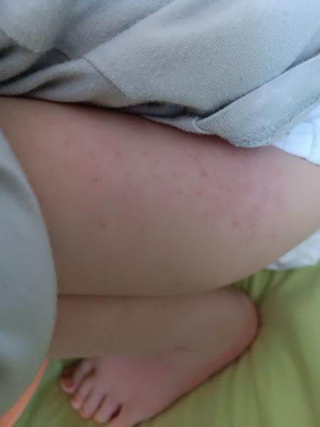 Môže potravinová alergia spôsobiť vyrážky bez svrbenia?