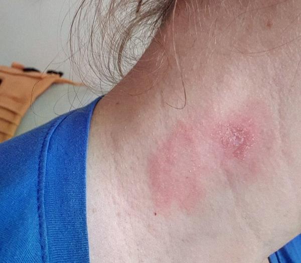 Mám atopický ekzém alebo seboreu?