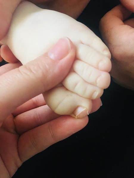 Má dcéra vpadnuté nechty na palcoch?