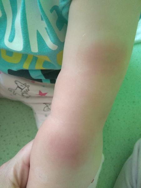 20. mesačnú dcérku niečo v noci poštípalo