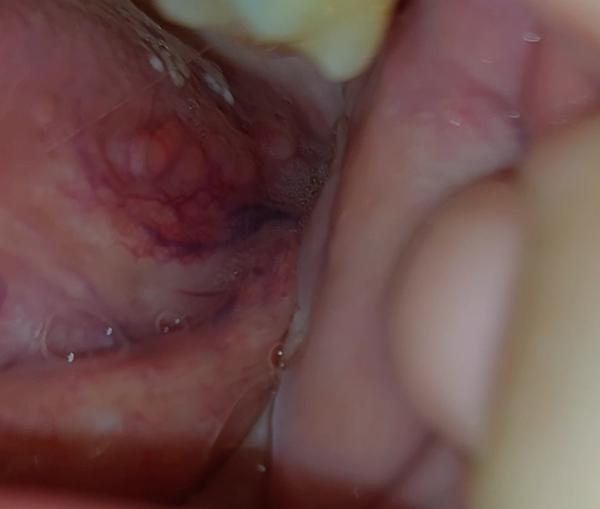 Kvôli čomu mám silné bolesti jazyka?